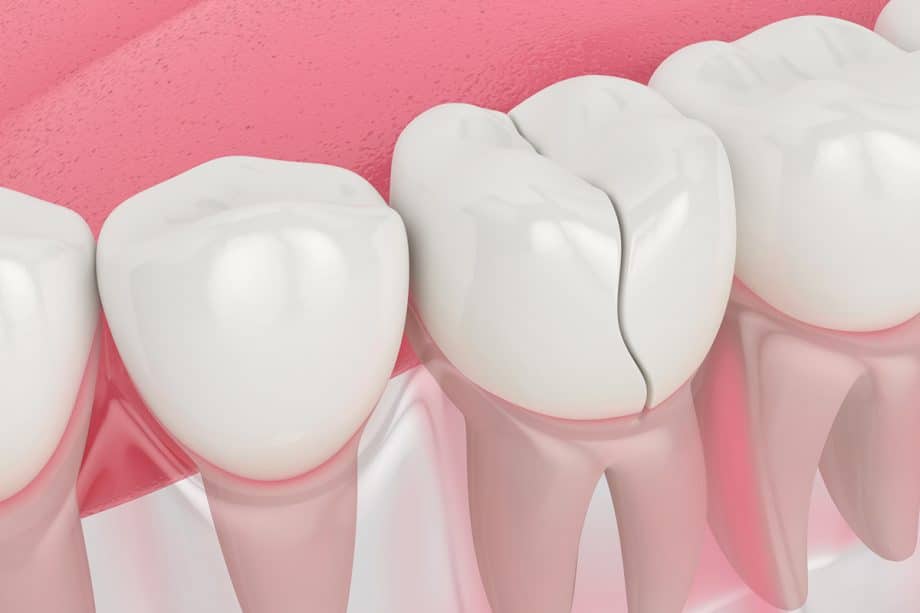 Can A Cracked Tooth Heal On Its Own?