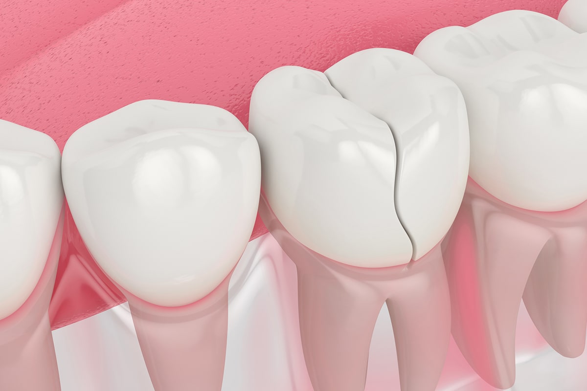Can A Cracked Tooth Heal On Its Own? Frisco, TX Dr. Cragun